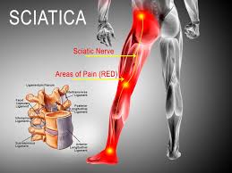 Sciatica